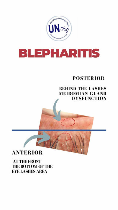 Blepharitis 